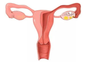 补佳乐 促进内膜生长,为胚胎宝宝 搭好温暖的床