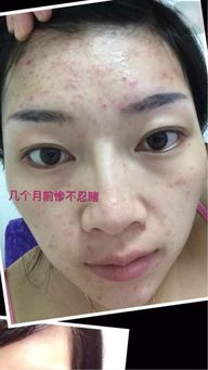 夏至长痘如何选择祛痘产品