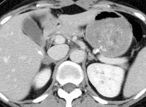 双侧肾上腺皮质增生怎么办 原因 检查 诊断 内科 肾内科 症状查询 寻医问药网