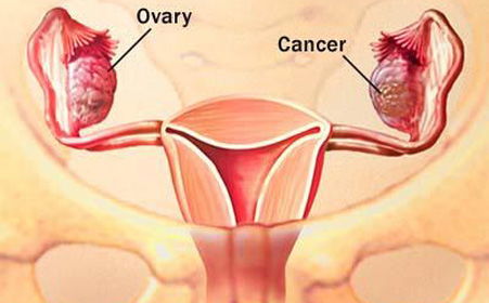 激素避孕药剂量与卵巢癌风险降低 剂量无关的保护效应
